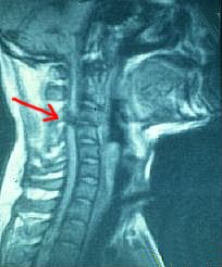 MRI scan of an individual with spinal cord injury showing a severed spinal column